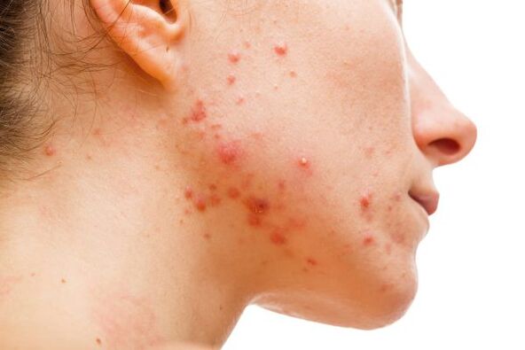 Acne caused by parasites under the skin