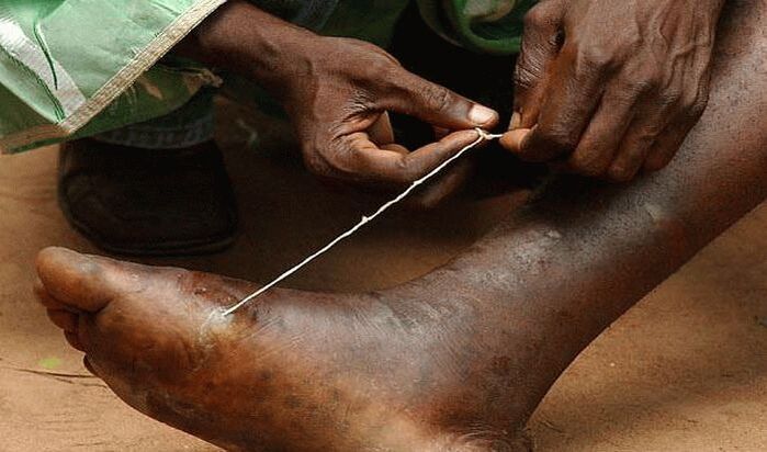 Extraction of subcutaneous parasites from feet