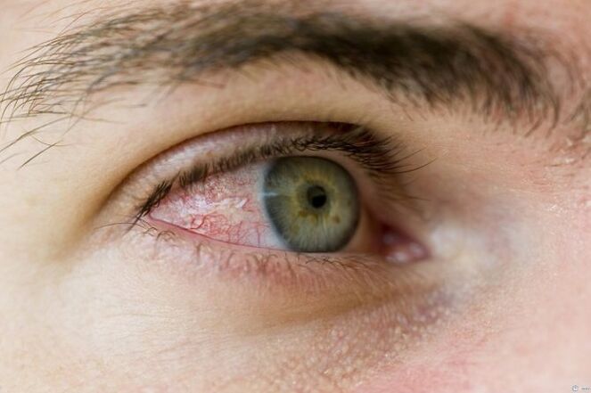 Eye problems caused by parasites