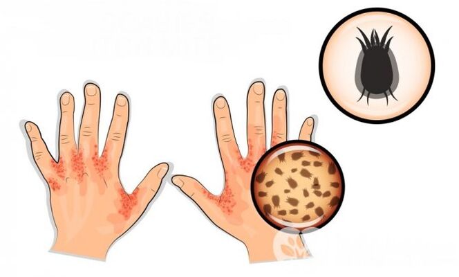 Human scabies caused by parasites