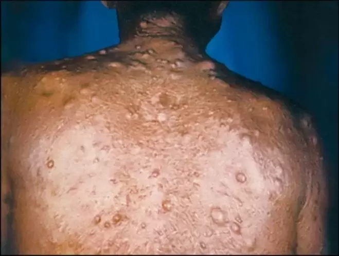 Purulent nodules on the skin due to parasites