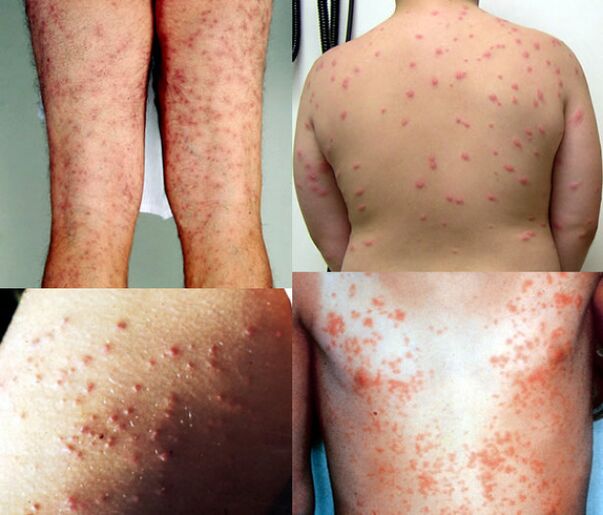 Skin rash all over your body due to parasites