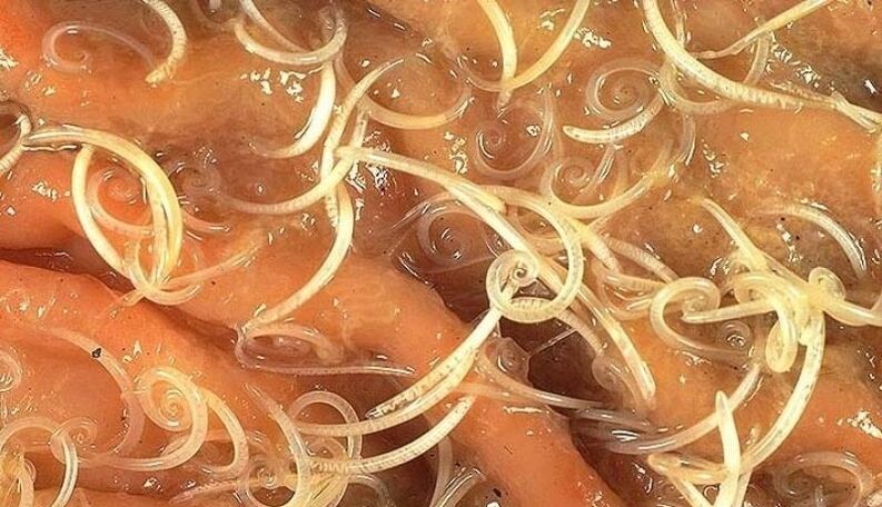 worms from human body